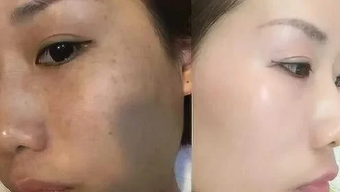 王者荣耀皮肤清洁与美白淡斑攻略