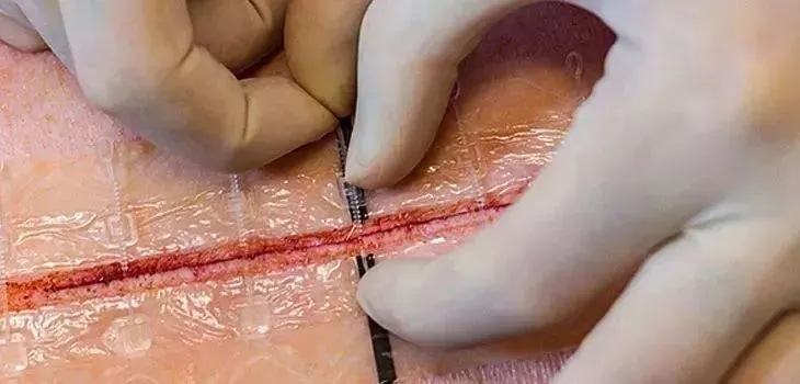 重结缔皮在哪剥